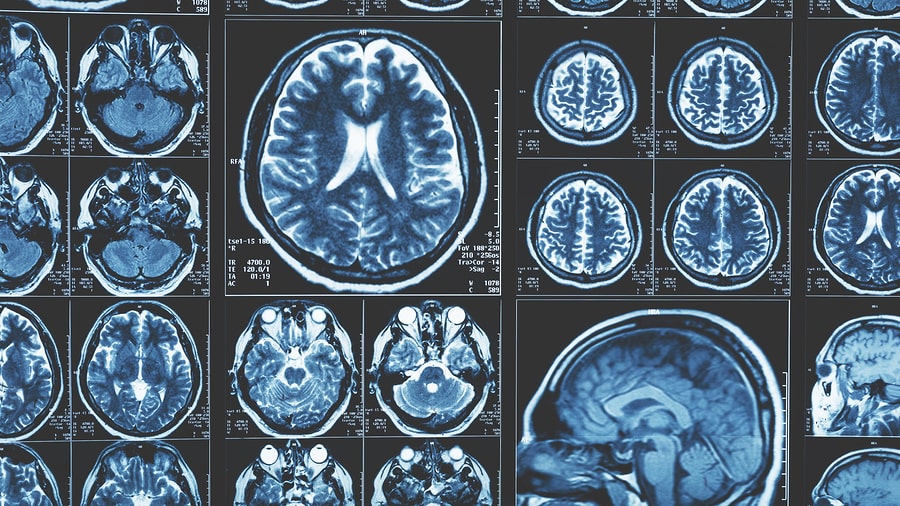 Traumatic brain injury scans