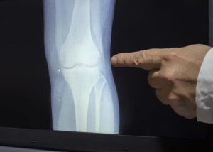 doctor pointing to joints in an x-ray