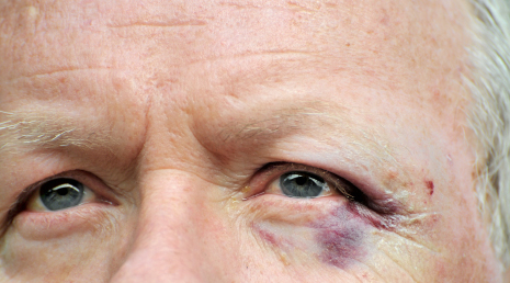 elderly man with black eye injury from nursing home
