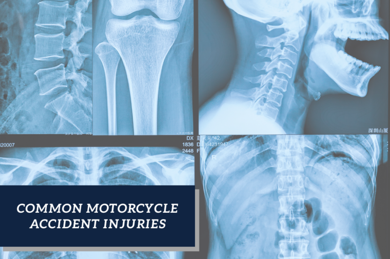 xray of different motorcycle accident injuries