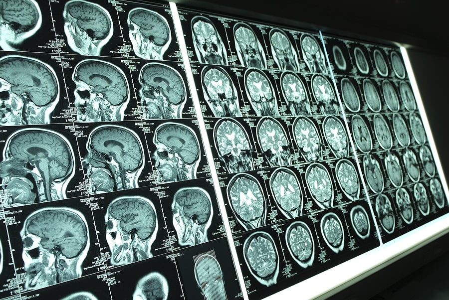 Anoxic brain injury being examined on scans