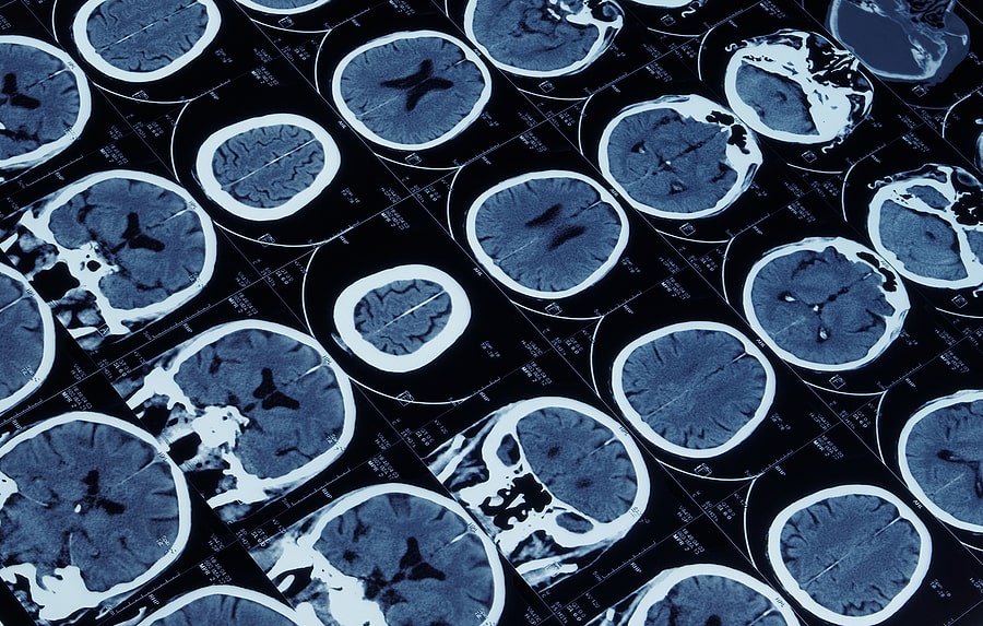 Brain scans being reviewed for traumatic brain injury
