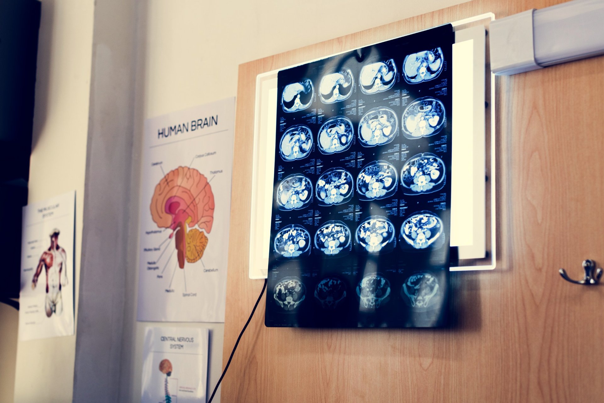 Brain MRI scan illuminated on a lightboard next to anatomical posters