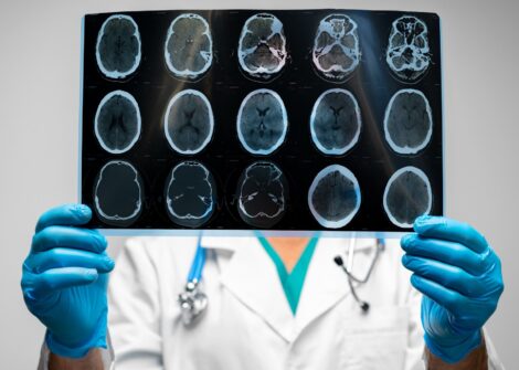 Doctor in gloves holding a brain MRI scan in front of their chest