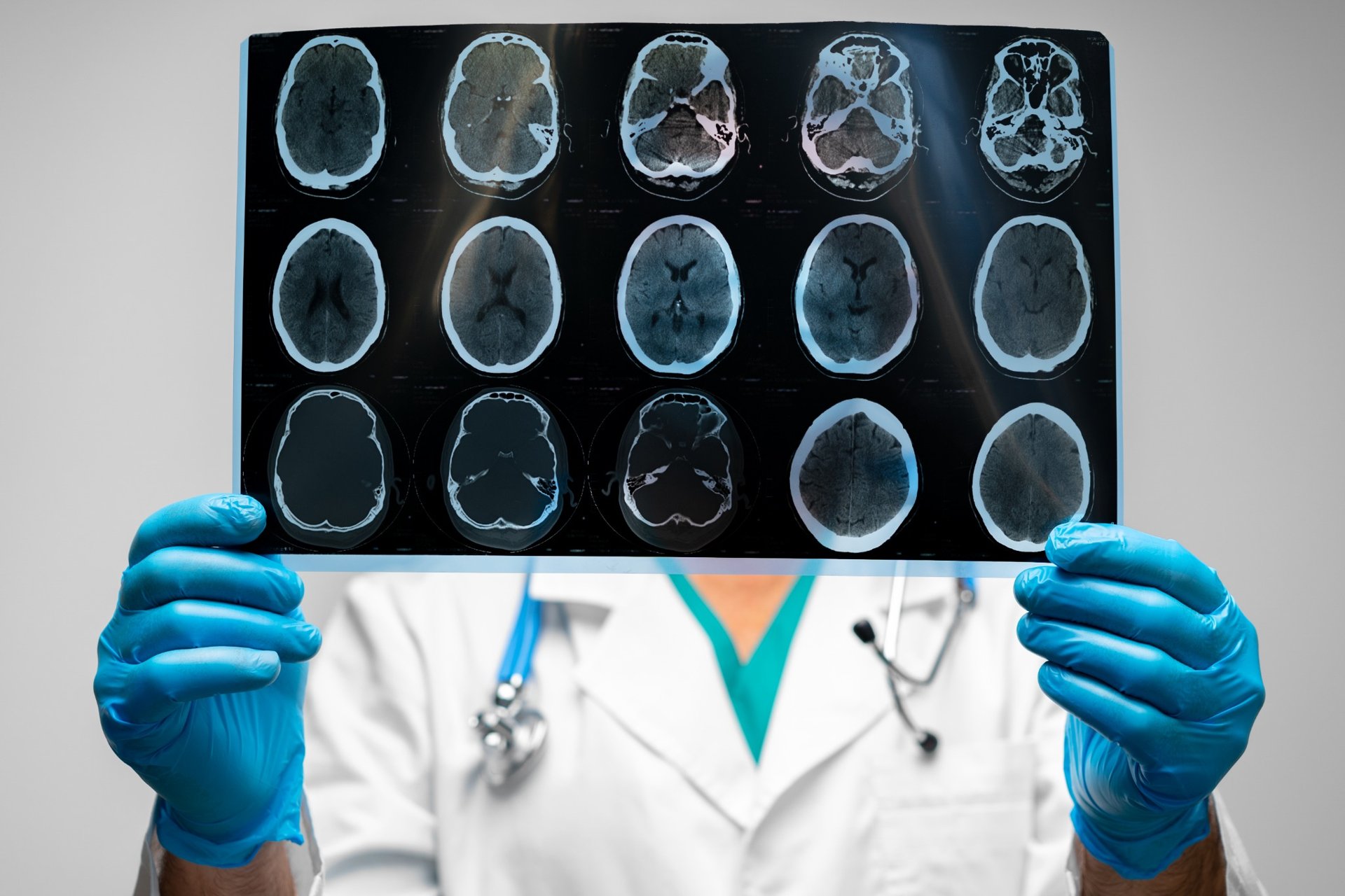 Doctor in gloves holding a brain MRI scan in front of their chest